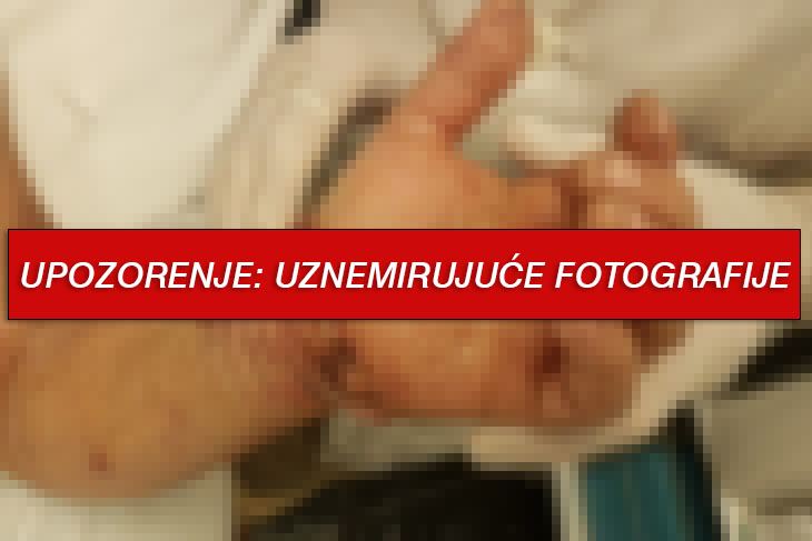 Draženu Bužanu je uspješno reimplantirana šaka (Foto: Glas Istre)