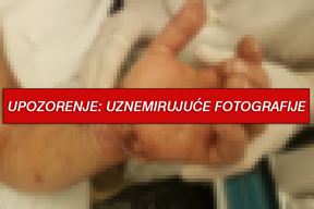 Draženu Bužanu je uspješno reimplantirana šaka (Foto: Glas Istre)