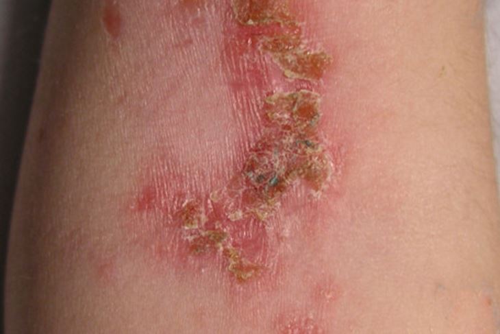 Impetigo se često pojavljuje na laktovima (Wikimedia)
