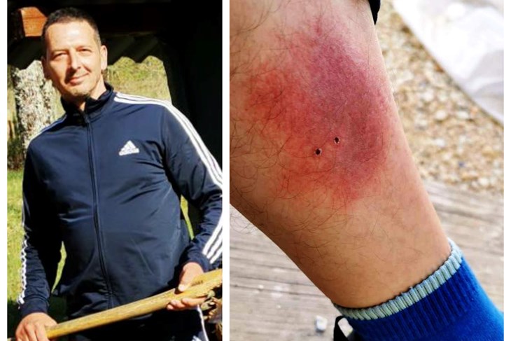 Mišel Đurina / Oko mjesta ugriza nakon nekoliko dana počela se stvarati oteklina